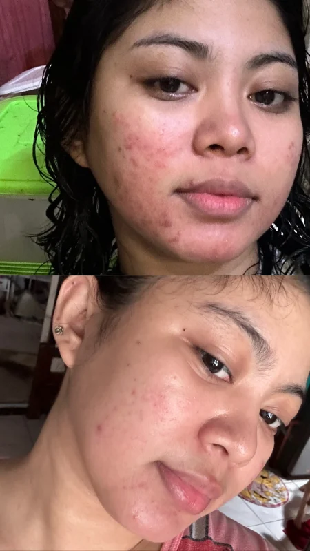 acne skin in Dubai